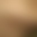 Stachelartige Hyperkeratosen bei Multiplem Myelom: Abb. entnommen aus&nbsp;Leerunyakul K et al. (...