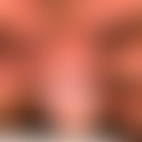 Differenzialdiagnose Lichen sclerosus: unscharf begrenzte weißliche Plaques. Juckreiz. Feingewebl...