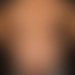 Naevus melanozytärer dysplastischer: multiple&nbsp;dysplastische Naevi bei fortgeschrittener Schw...
