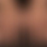 Pseudoleukoderm:&nbsp; Zustand nach lokaler Therapie der Psoriasis.&nbsp;
