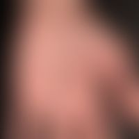 Psoriasis palmaris et plantaris: trocken-keratotischer Plaque-Typ. Chronische, scharf begrenzte, ...