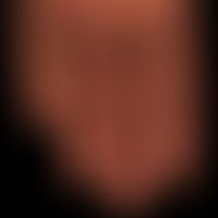 Erythema multiforme: plötzlich aufgetretenes, seit etwa 2 Wochen&nbsp;bestehendes, juckendes, dis...