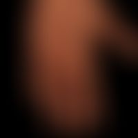 Erythema multiforme (dunkle Haut): plötzlich aufgetretenes, seit etwa 2 Wochen&nbsp;bestehendes, ...