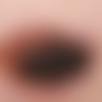 Melanom, noduläres. "seit Jahren bekannter, solitärer, über Jahre symptomloser, seit 2 Monaten st...
