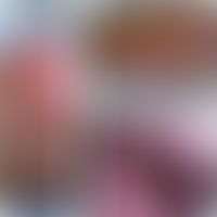 Erythema migrans arciforme et palpabile: randbetonte, zentral deutlich abgeblassste Plaque. Oberf...