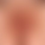Vuvla:&nbsp;massives, rechtsseitiges Lymphödem der kleinen Schamlippe.&nbsp;
