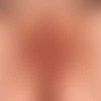Vuvla:&nbsp;massives, rechtsseitiges Lymphödem der kleinen Schamlippe.&nbsp;
