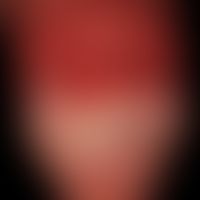 Akute Balanitis als Manifestaiton einer fixen Arzneimittelreaktion. Flächige Ablösung des Epihels.
