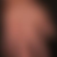 Toxische epidermale Nekrolyse: TEN: generalisierte klein- und großblasige Arzneimittelreaktion.&n...