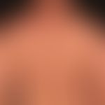 Differenzialdiagnose Mucinosis follicularis:&nbsp; disseminierte, 0,1 cm große,&nbsp;hautfarbene,...