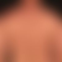Differenzialdiagnose&nbsp;Keratosis pilaris simplex

Diagnose: Follikulotrope Mycosis fungoides
