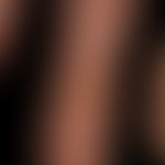Verrucae vulgares: flächiges Warzenbeet mit subungualer Infiltration. Langsames peripheres Fortsc...