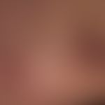Melanom: diffuse, kutane Metastasierung (melanotische und amelanotische Metasen) im Bereich der T...