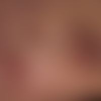 Melanom: diffuse, kutane Metastasierung (melanotische und amelanotische Metasen) im Bereich der T...