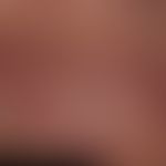 Melanom: diffuse, kutane Metastasierung (amelanotische Metasen) im Bereich der Thoraxwand.&nbsp;
