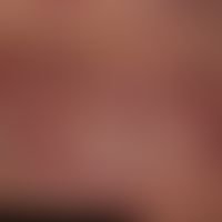 Melanom: diffuse, kutane Metastasierung (amelanotische Metasen) im Bereich der Thoraxwand.&nbsp;
