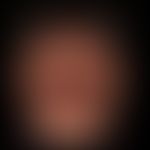 Hyperpimgentierungen: chronische flächige Hyperpigmentierungen (Periorbitalregion ausgespart) nac...