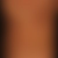 Erythema multiforme (Detail):&nbsp;42-jährige Patientin mit akutem Exanthem.&nbsp;Multiple, akut ...