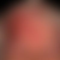 Pemphigoid vernarbendes Typ Brunsting-Perry (Folgeaufnahme 1,5&nbsp;Jahre unter immunsuppressiver...