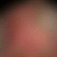 Pemphigoid vernarbendes Typ Brunsting-Perry (Folgeaufnahme 2&nbsp;Jahre unter immunsuppressiver T...