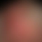 Differenzialdiagnose: Lupus erythematodes chronicus discoides

Diagnose: Pemphigoid vernarbendes ...