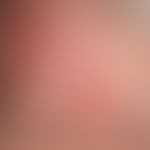 Alopezie vernarbende: vernarbende Haarlosigkeit durch vernarbendes Pemphigoid Typ Brunsting-Perry

