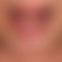 Cheilitis actinica chronica: schuppige flächige Leukoplakie mit Rhagadenbildung.
