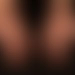 Differenzialdiagnose: Palmarerythem

Diagnose: Lupus erythematodes, subakut-kutaner mit&nbsp;mult...