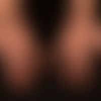 Differenzialdiagnose: Palmarerythem

Diagnose: Lupus erythematodes, subakut-kutaner mit&nbsp;mult...