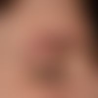 Differenzialdiagnose: Ulerythema ophryogenes

Diagnose: Lupus erythematodes, subakut-kutaner (Tei...