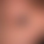Merkelzell-Karzinom:&nbsp;derber, verschieblicher, nicht schmerzender Tumor im Bereich der Wange ...