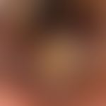 Merkelzell-Karzinom: Auflichtmikroskopisches Bild. Randbereich mit ektatischen Kapillaren. Zentru...