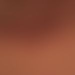 Follikulitis: Follikulitiden bei Acne keloidalis nuchae.

