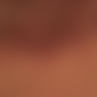 Follikulitis: Follikulitiden bei Acne keloidalis nuchae.
