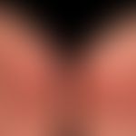 Kontakdermatitis allergische:&nbsp; subkaute stellenweise nässende allergische Kontaktdermatitis....