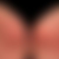 Differenzialdiganose: Kontaktdermatitis toxische

Diagnose:&nbsp;Kontaktallergische Dermatitis mi...