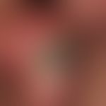 Fournier Gangrän:&nbsp;tiefreichende Nekrose an der Glans penis mit aufliegender schwarzer Nekros...