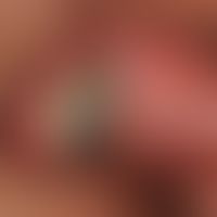 Ulcus molle:&nbsp; foudroynat verlaufende Infektion bei Doppelinfektion (HIV-Infektion)
