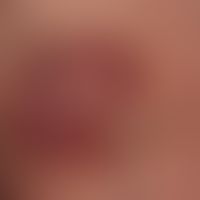 Basalzellkarzinom, superfizielles:&nbsp;scharf begrenzte, zentral leicht atrophische, schuppende,...