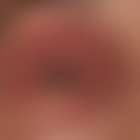 Atopische Liddermatitis: chronisch persistierende&nbsp;atopische&nbsp;Liddermatitis mit unscharf ...