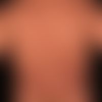 Acne conglobata: Narbensituation nach 1-jähriger Behandlung.

&nbsp;
