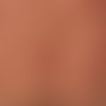 Follikulitis&nbsp;(Acne conglobata): gelb eingekreist entzündliche follkuläre Papeln. Follikel pr...
