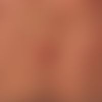 Follikulitis&nbsp;(Acne conglobata): gelb eingekreist entzündliche follkuläre Papeln. Follikel pr...