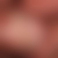 Lichen sclerosus: massiver Befall von Vorhaut und Glans penis.&nbsp;
