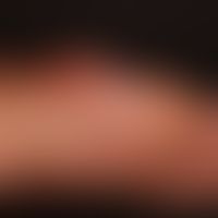 Panaritium (Detailaufnahme): schmerzhafte Schwellung und Rötung des linken Zeigefingers.&nbsp; &n...