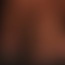 Panaritium: schmerzhafte Schwellung und Rötung des linken Zeigefingers.&nbsp; &nbsp; &nbsp;
