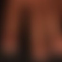 Panaritium: schmerzhafte Schwellung und Rötung des linken Zeigefingers.&nbsp; &nbsp; &nbsp;
