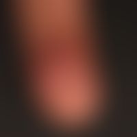 Panaritium (Detailaufnahme): schmerzhafte Schwellung und Rötung des linken Zeigefingers.&nbsp; &n...