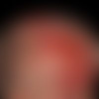 Ulkus der Haut: flächige und schmerzhafte Ulkusbildung bei Arteriitis temporalis&nbsp;
