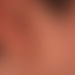 Naevus, epidermaler:&nbsp;seit Geburt bestehende, erhabene, symptomlose, linear angeordnete, plan...